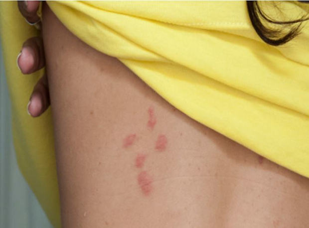 close-up of bed bug bites on upper back of woman