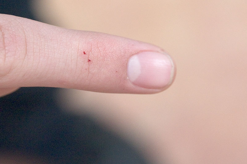 Black widow bite on finger